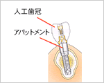 図：人工歯冠　アバットメント