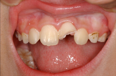歯の予防について